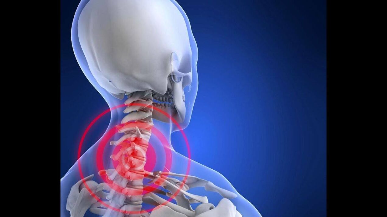 Osteohondroza grlića maternice