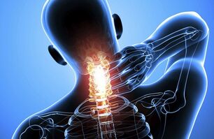 Cervikalna osteohondroza