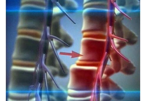 Stiskanje živčanih završetaka u lumbalnoj osteohondrozi
