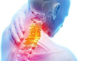 Glavni znakovi i simptomi cervikalne osteohondroze