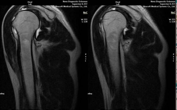 X-zraka za dijagnosticiranje artroze ramena