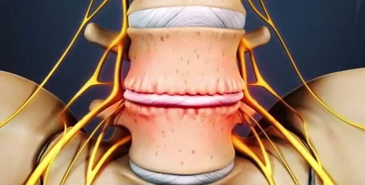 lezije kralježnice zbog osteohondroze